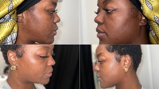 Getting Rid Of Discoloration  Dark Spots  AnaRui Tumeric Clay Mask amp Oil  Results In 2 Weeks [upl. by Seymour]