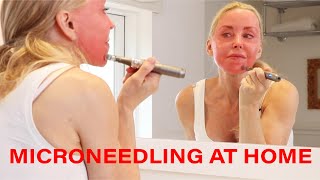 Microneedling DIY at Home  Tips Warnings and Demo  Over 50 [upl. by Savihc]