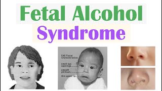 Fetal Alcohol Syndrome FAS  Risk Factors Pathophysiology Signs amp Symptoms Diagnosis Treatment [upl. by Arraeic927]