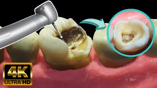 Endodoncia en muela con caries profunda  Tratamiento de conducto [upl. by Pickering279]