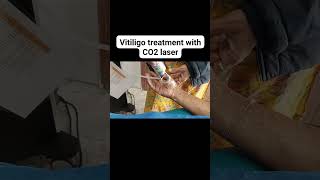 Vitiligo treatment with CO2 laser [upl. by Anahsit577]