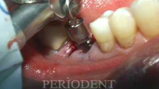 Molar Extraction and Immediate Implant Placement [upl. by Inram]