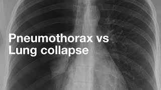 Pneumothorax vs Lung Collapse [upl. by Ayrolg598]