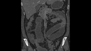 Adhesions causing small bowel obstruction  CT findings [upl. by Randy]