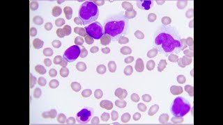 Acute myeloid Leukaemia with translocation 9 and 11 [upl. by Artinahs143]