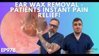 EAR WAX REMOVAL  PATIENTS INSTANT PAIN RELIEF  EP978 [upl. by Elleynad]