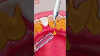 The surprising truth about ASMR teeth cleaning [upl. by Enelia367]