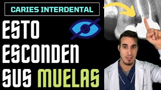 Te SORPRENDERÁ lo que ESCONDEN estas muelas  CARIES INTERDENTAL O INTERPROXIMALES [upl. by Ziom]