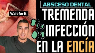 Tremenda INFECCIÓN con FLEMÓN o ABSCESO DENTAL  Todo esto tenía dentro de la ENCÍA [upl. by Ingaberg]