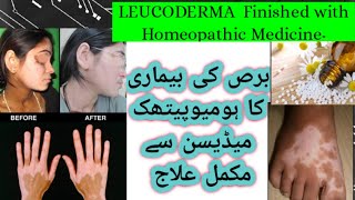 quotLeukoderma Leucoderma Treatment with homeopathic RemedyquotDoctor Abida [upl. by Idnerb662]