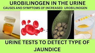 UROBILINOGEN IN THE URINE INCREASEDCAUSES SYMPTOMS OF HIGH UROBILINOGENURINE TEST FOR JAUNDICE [upl. by Fiedling]