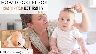 How to Get Rid of Cradle Cap FAST  Best Cradle Cap Remedy [upl. by Shakti]