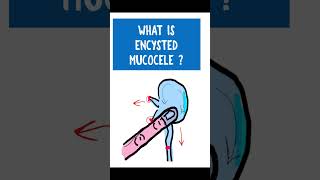 ENCYSTED MUCOCELE  Chronic dacryocystitis opthalmology [upl. by Asserat]