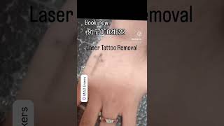 madinkers lasertattooremovalspecialist lasertattooremoval youtubeshorts youtube Follow us🙏🔥 [upl. by Cheyney792]