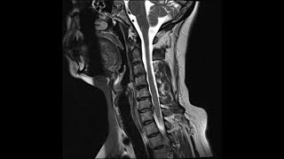 Avaliação Hérnia de Disco e Protusão Cervical  Clínica de Fisioterapia Dr Robson Sitta [upl. by Ellehcor]