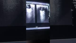 B Scan  ultrasound eye vitreous hemorrhage [upl. by Irma590]