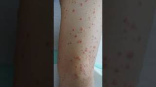 Guttate psoriasis  psoriasis skin psoriasisawareness psoriasissolution dermestidscanada short [upl. by Hayalat]