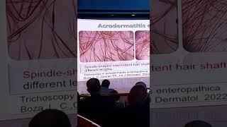 Trichoscopy Hair Shaft disease [upl. by Aifas415]