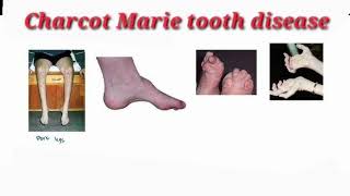 Charcot Marie tooth disease mrcpch Clinical [upl. by Ytsrik]