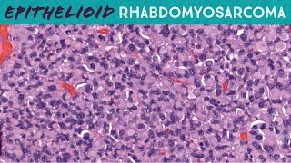 Epithelioid Rhabdomyosarcoma in Skin Emory case 4 rhabdoid cytology dermpath pathology dermatology [upl. by Ahto]