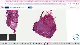 Cellular neurothekeoma and follicular neoplasm neurofibroma [upl. by Ashli]