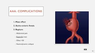 EVAR of Abdominal Aortic Aneurysm and Iliac Aneurysm [upl. by Glasgo349]