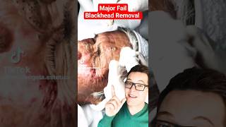 OMG Worst BLACKHEAD REMOVAL 2024  Fail shorts [upl. by Bosson649]