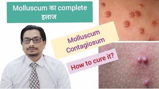 Molluscum Contagiosum Treatment  molluscum contagiosum removal  molluscum contagiosum in Hindi [upl. by Nostrebor]