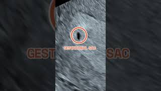 Your baby at 4 weeks pregnant  Early Ultrasound Scan [upl. by Ttemme362]