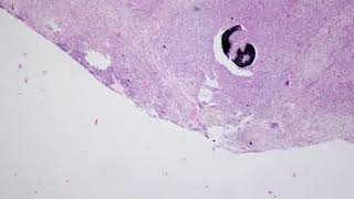 Actinomycosis in Liver with GMSHaematoxylin and Eosin Staining [upl. by Nitsirk]