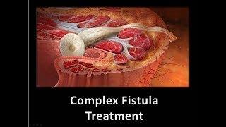 Complex Fistula Treatment [upl. by Jabon416]