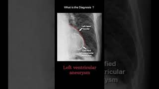 Left ventricular aneurysm 156 chest xray Quiz Cardiac Disease radiologychannel007 [upl. by Nagek357]