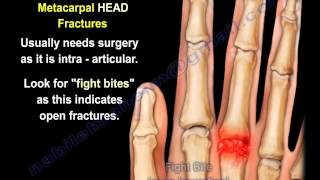 Metacarpal Fractures  Everything You Need To Know  Dr Nabil Ebraheim [upl. by Anihcak]