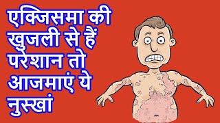 Home Remedies for Eczema  एक्‍जिमा की खुजली  आजमाएं ये नुस्‍खा eczema eczemacure health [upl. by Fontana]