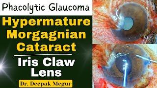 Iris Claw Lens Phacolytic Glaucoma amp Morgagnian CataractInadvertent Intracapsular Extraction [upl. by Olmsted]