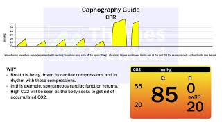 Capnography Waveforms CPR [upl. by Aeneas]