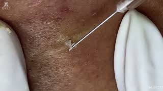 Big Cystic Acne Blackheads Extraction Blackheads amp Milia Whiteheads Removal Pimple Popping [upl. by Yadsendew]