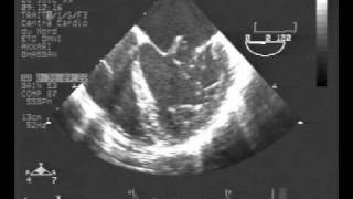 infective endocarditisTEE chordal rupture of both leaflets of the mitral valve [upl. by Yadroc]