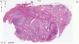 Hashimoto Thyroiditis  Histopathology [upl. by Alimak]