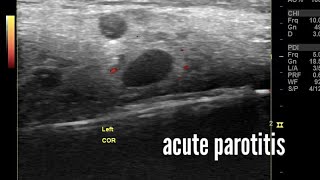 Acute parotitis ultrasound and color Doppler imaging video [upl. by Thunell]