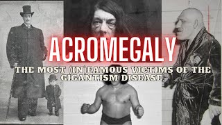 ACROMEGALY The Most InFamous Victims Of The Gigantism Disease  Full Pictures [upl. by Hacissej405]