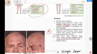 Virus Varicella Zoster  Varicella Cacar Air dan Herpes Zoster [upl. by Eniruam]