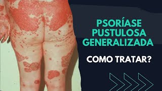 PSORÍASE PUSTULOSA GENERALIZADA COMO TRATAR  SAIBA [upl. by Sholeen334]