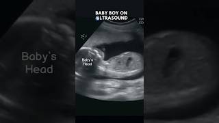 Ultrasound Showing Baby Boy  Gender Reveal 👶shorts trendingshorts viralvideo trendingreels [upl. by Huai]