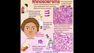 actinomyosis amp rhinsleroma granuloma 3 s [upl. by Feliks342]