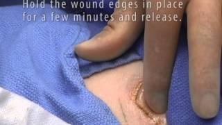 dermaflex® QS™ Trauma Wound Application [upl. by Carpio980]