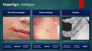 Impetigo Subtypes [upl. by Grissom]