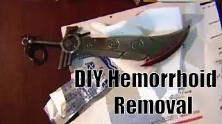 DIY Hemorrhoid Removal [upl. by Eedeed]