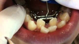 Lower Teeth Expander Getting Braces On Nirenblatt Orthodontics [upl. by Llorrad]