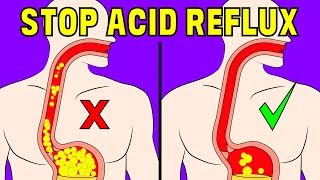 The 4 minute natural trick to prevent acid reflux in the oesophagus [upl. by Lorsung]